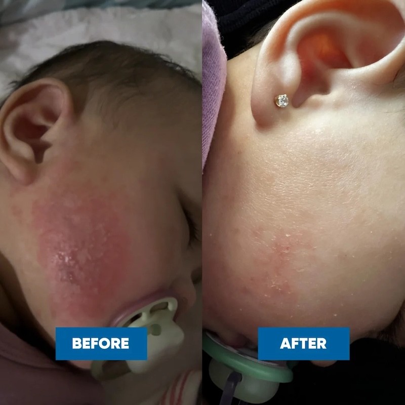 A before and after photo of a baby with eczema on its cheek