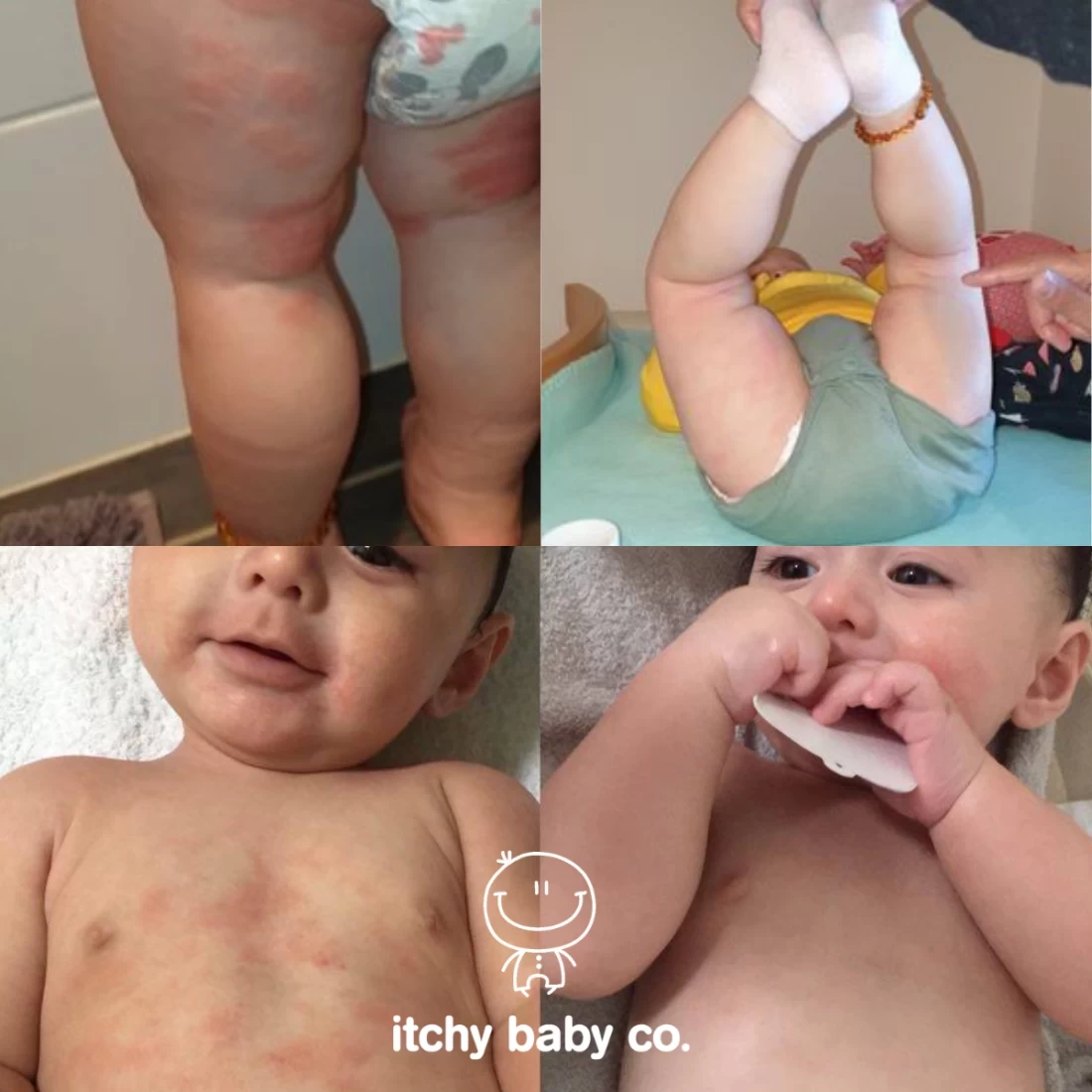 Itchy Baby Co Eczema Moisturiser in four images documenting baby’s eczema healing – trusted best eczema cream for babies